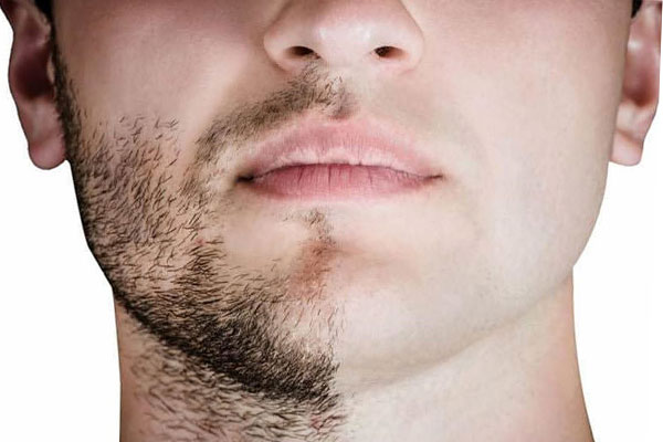 کاشت ریش و سبیل