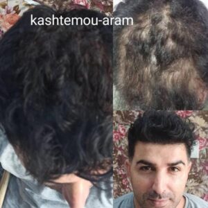 کاشت مو - کلینیک آرام