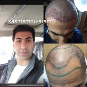 کاشت مو - کلینیک آرام