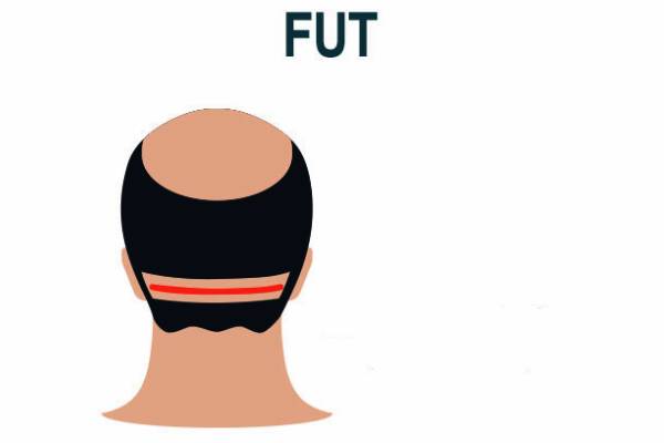 کاشت مو به روش FUT