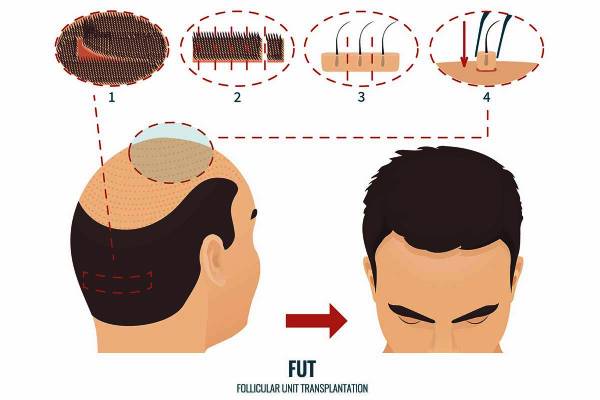 کاشت مو به روش FUT