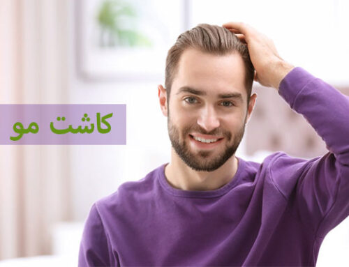 عمل کاشت مو