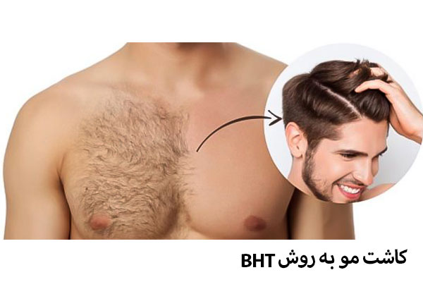 کاشت مو به روش bht