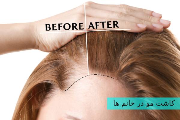کاشت مو در خانم ها