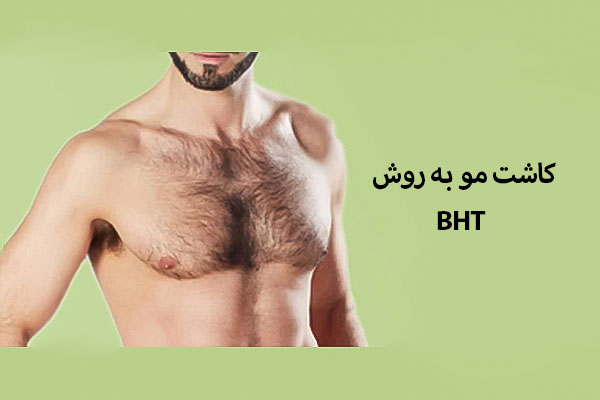 کاشت مو به روش BHT