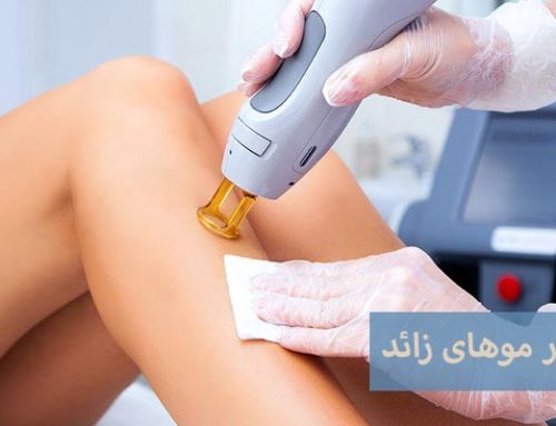 لیزر موهای زائد