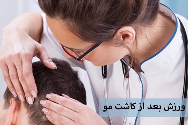 ورزش بعد از کاشت مو