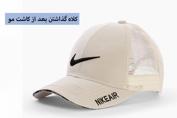 کلاه گذاشتن بعد از کاشت مو