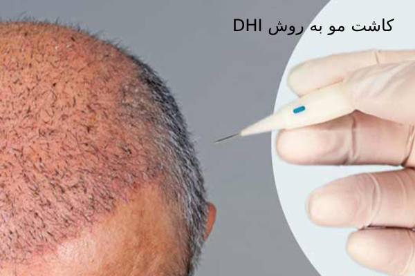 کاشت مو به روش DHI