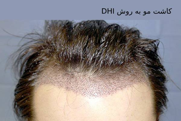 کاشت مو به روش DHI