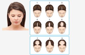 ریزش مو آندروژنیک