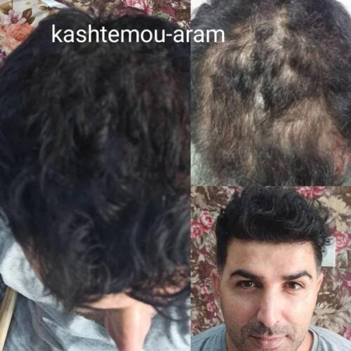 کاشت-مو-1